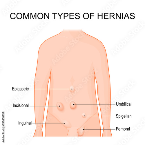 Hernia types. Common sites for hernias