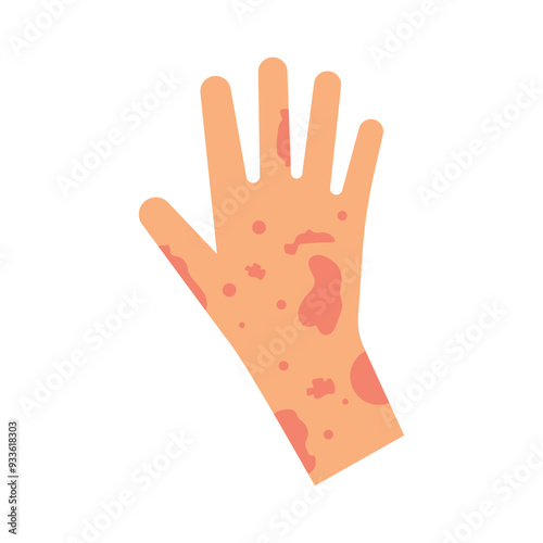 Skin rash, insect bites allergy reaction. irritation on hand logo vector illustration