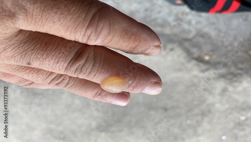 Blisters on the finger due to rubbing with hot water or being exposed to heat on the skin, risking infection. Burn Management 