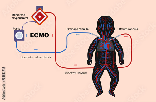 Extracorporeal membrane oxygenation