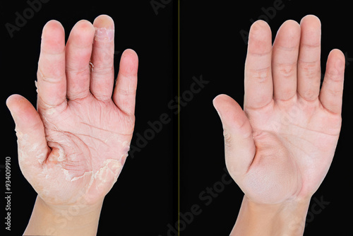 One man hand with psoriasis on it and the other man hand with healthy skin. photo