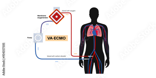 Extracorporeal membrane oxygenation