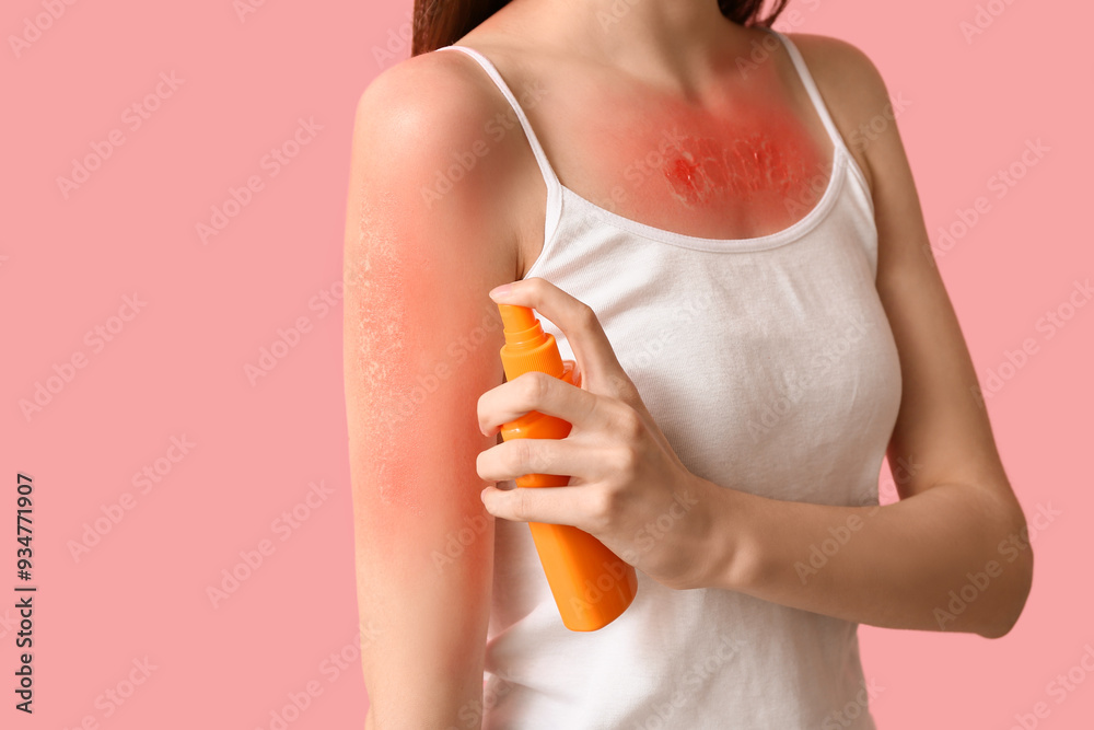 Young woman with red sunburned skin applying cream on pink background Young woman with red sunburned skin applying cream on pink background