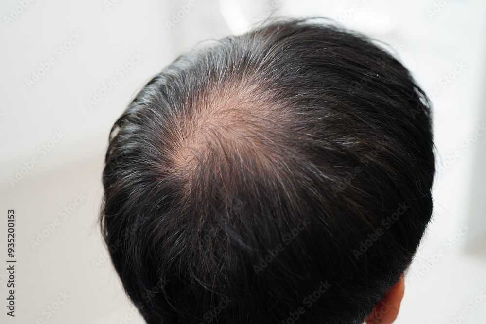 Fototapeta premium Bald head in man, hair loss treatment health problem.