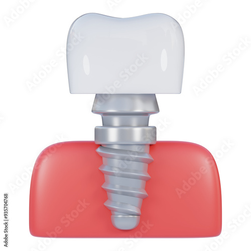 dental implant 3d icon illustration