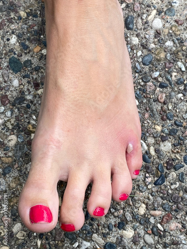 MRSA Foot