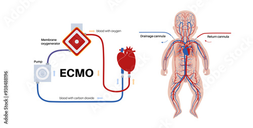 Extracorporeal membrane oxygenation