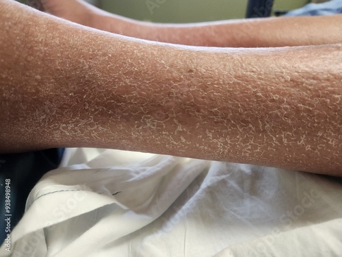 Pembroliimab rash with edema and desquamation - cancer patient