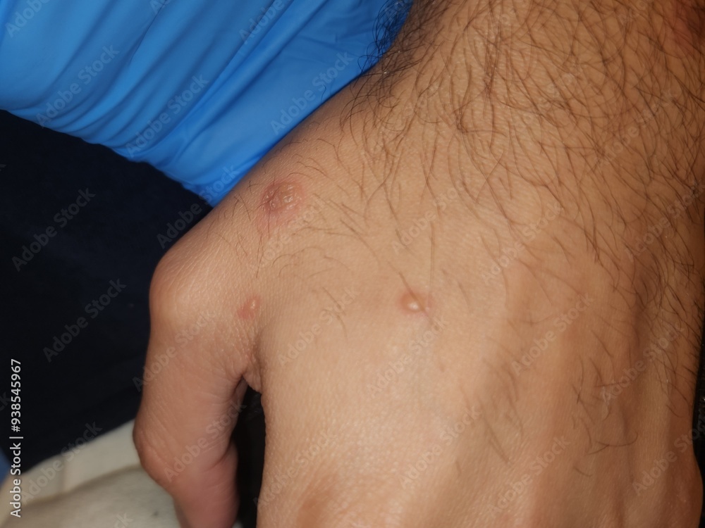 Naklejka premium Monkeypox disseminated skin lesions - gay white male