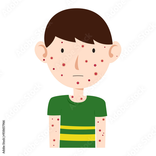 chicken pox virus infection disease