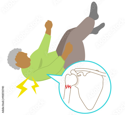 Preferred sites of fall fractures in the elderly due to osteoporosis. Shoulder fractures
