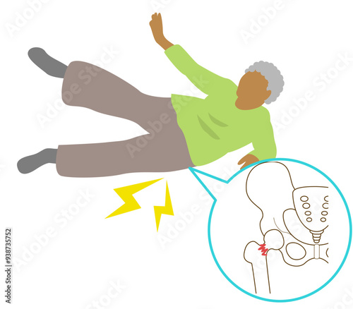 Preferred site of fall fractures in the elderly due to osteoporosis. Fracture of the base of the foot