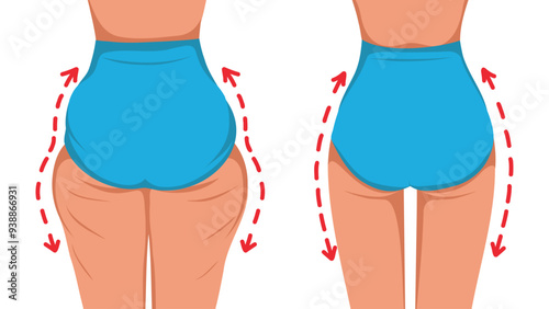 Female body before and after. Massage and taping for slimming the thighs, removal of ears on the thighs. Vector template for advertising, website, banner, posters, cover.
