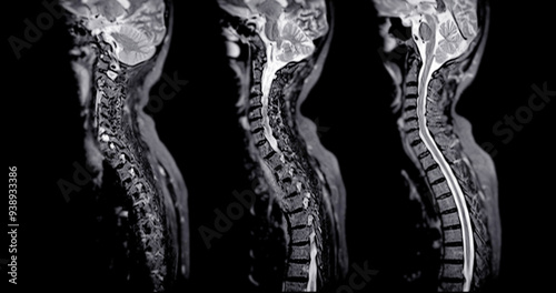 MRI of C-spine or magnetic resonance image of cervical spine sagittal view for diagnosis spondylosis and compression fracture.