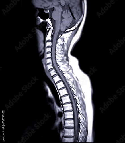 MRI of C-spine or magnetic resonance image of cervical spine sagittal view for diagnosis spondylosis and compression fracture.