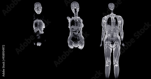MRI whole body scans are beneficial for early cancer detection, monitoring chronic conditions, and overall health assessments.