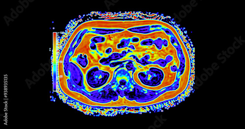 An MRI PET scan of the abdomen in axial view provides a detailed cross-sectional image, helping to detect abnormalities with high precision.