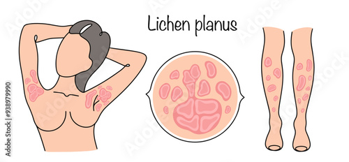 Lichen planus photo