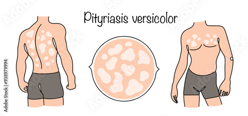 Pityriasis versicolor