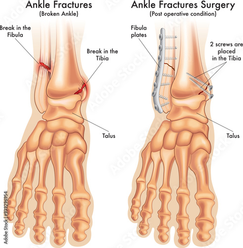 medical illustration compares a fractured ankle before and after surgery, with annotations.