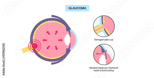 Glaucoma eye disease