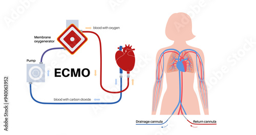 Extracorporeal membrane oxygenation