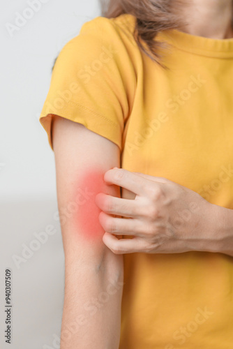 Wallpaper Mural woman itching and scratching itchy arm. Sensitive Skin Allergic reaction to insect bite, food, drug dermatitis. Dermatology, Leprosy day, Systemic lupus erythematosus, Allergy symptoms and rash Eczema Torontodigital.ca