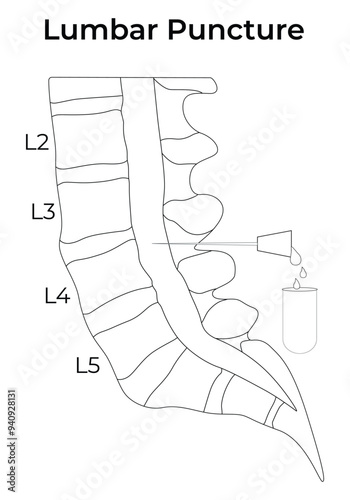 Lumbar Puncture Science Design Vector Illustration Diagram