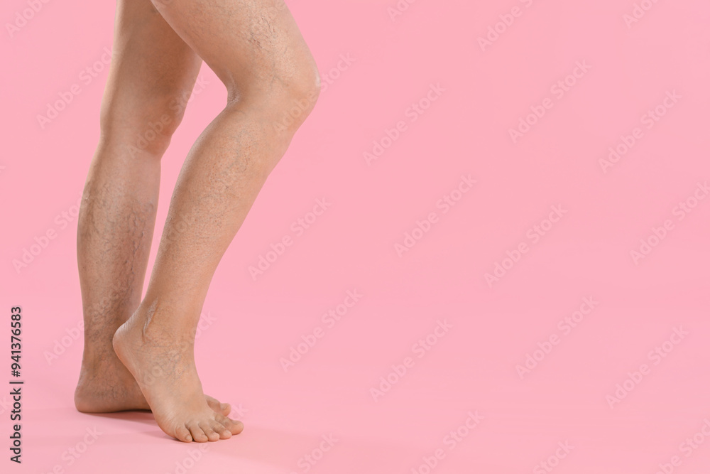 Woman with varicose veins on pink background, closeup. Space for text Woman with varicose veins on pink background, closeup. Space for text