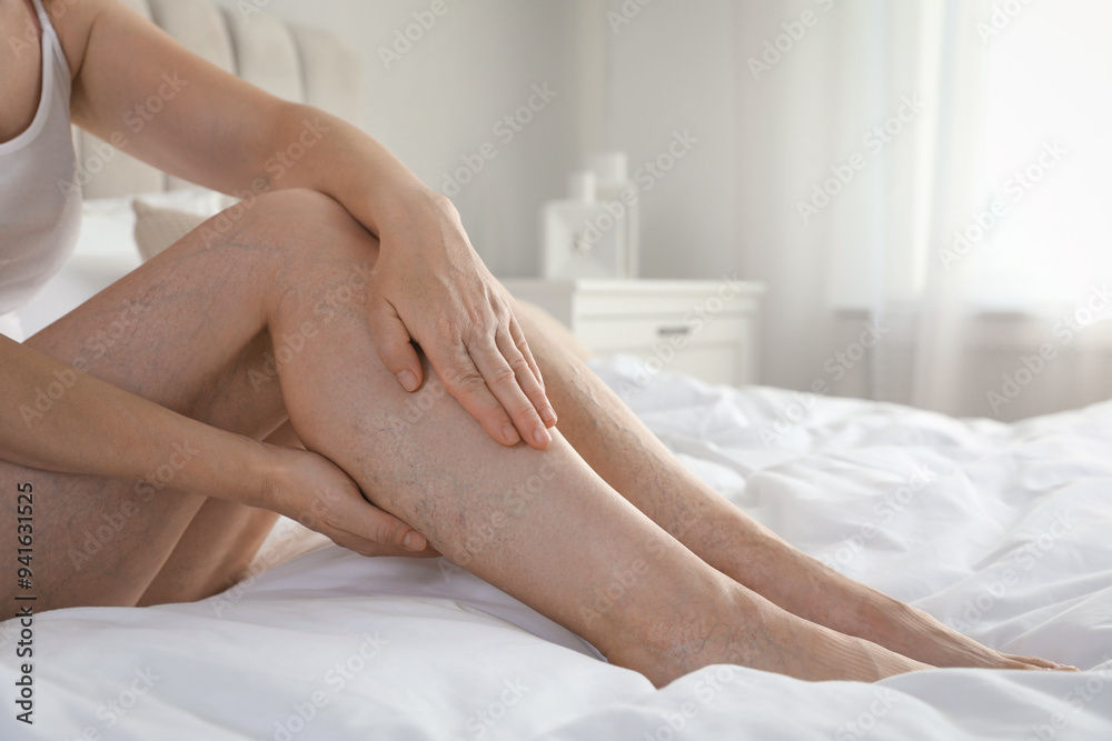 Fototapeta premium Woman suffering from varicose veins on bed indoors, closeup