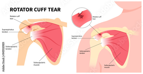 Shoulder joint bone of the upper arm and Degenerative rotator cuff muscle tear disease or injury photo