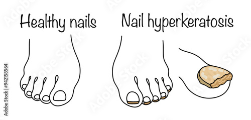 Nail hyperkeratosis