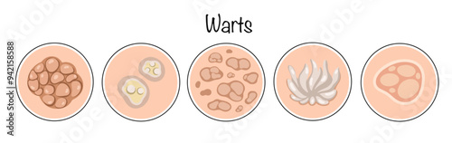 Warts
