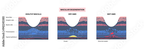 Macular degeneration poster