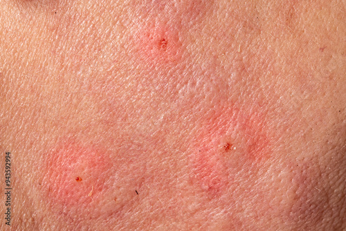 Close up of irritated skin showing redness and inflammation