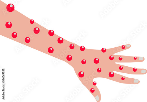 Monkeypox Rashes on the Hand Illustration