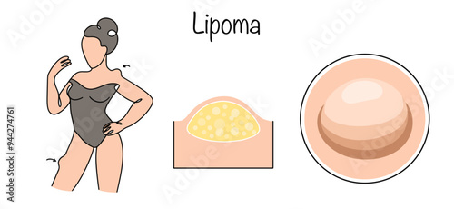 Lipoma