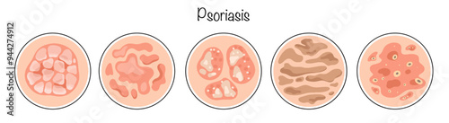 Psoriasis