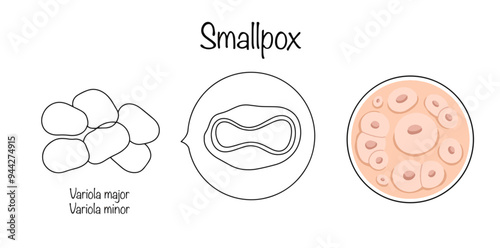 Smallpox