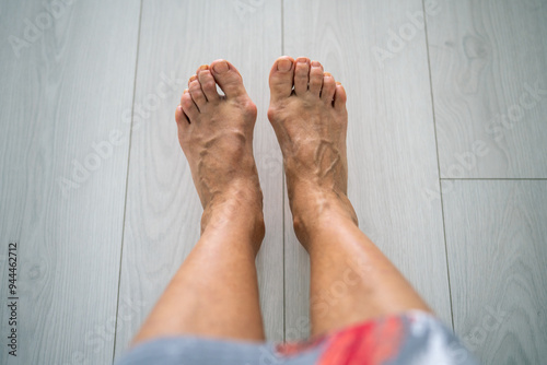 Cropped elderly woman varicose bare feet with growth, valgus deformity. Aged female tolerate distress, fatigue post pedestrian activity due to foot excrescence, pain, inflammation, orthopaedics need