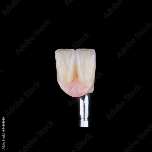 Two dental crowns with artificial gum made of zirconium on titanium abutment for fixation to implant