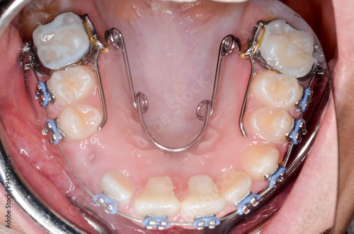 Canvas Print dental mirror and teeth, braces, palatal bar