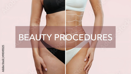 Female body before and after liposuction. Weight loss and skin care concept. Plastic surgery, overweight problems. Background for clinic, banner, flyer photo