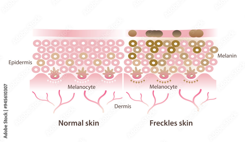 Comparison of normal and freckles skin vector illustration isolated on white background. Cross section of healthy skin layer and melanocytes make more melanin that develop to small flat brown spots. Comparison of normal and freckles skin vector illustration isolated on white background. Cross section of healthy skin layer and melanocytes make more melanin that develop to small flat brown spots.