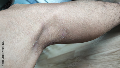 Paederus dermatitis, medically known as dermatitis linearis. You will feel burning pain, burn marks, and blisters or rashes. that looks like herpes or shingles. Footage After get the medicine