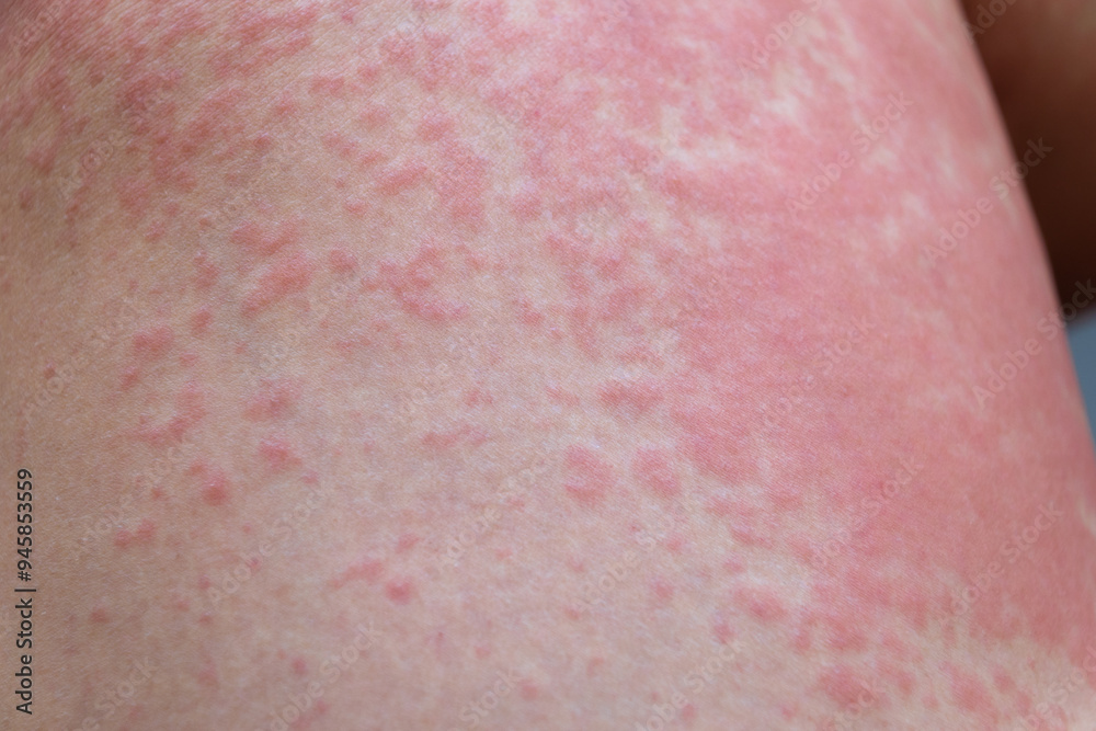 Allergic rash on the leg. Photodermatitis. Allergy to the sun, ultraviolet. Allergic rash on the leg. Photodermatitis. Allergy to the sun, ultraviolet.