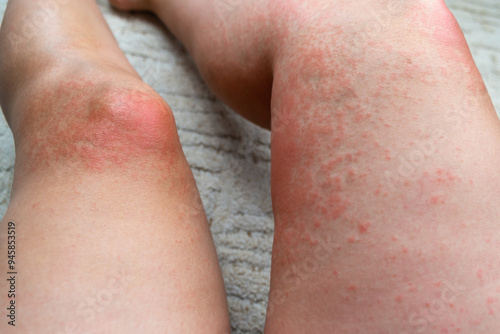 Allergic rash on the leg. Photodermatitis. Allergy to the sun, ultraviolet. photo