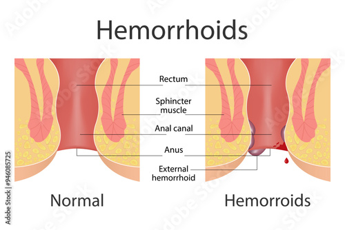 Hemorrhoids and inflammation cause bleeding through the patient's fistula. Cross-section of the rectum and anal canal
