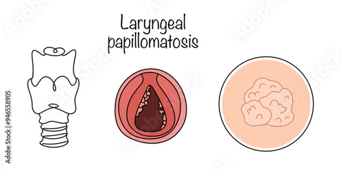 Laryngeal papillomatosis photo