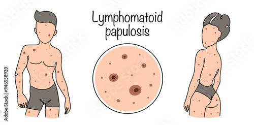 Lymphomatoid papulosis